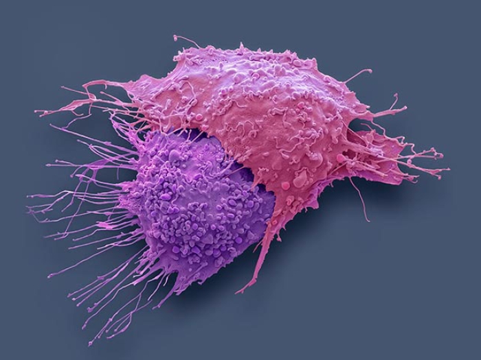 Immune Cells Help Reverse Chemo Resistance In Ovarian Cancer