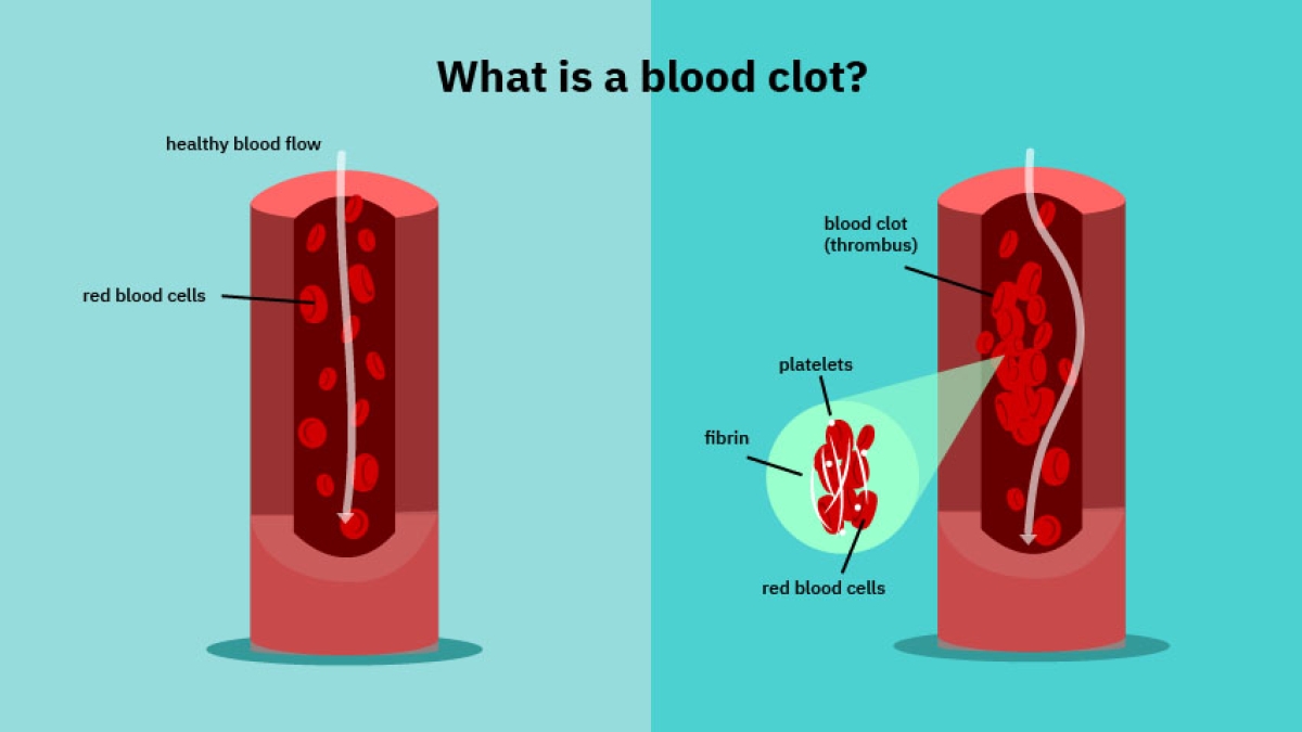Symptoms of Blood Clot in Leg • MyHeart
