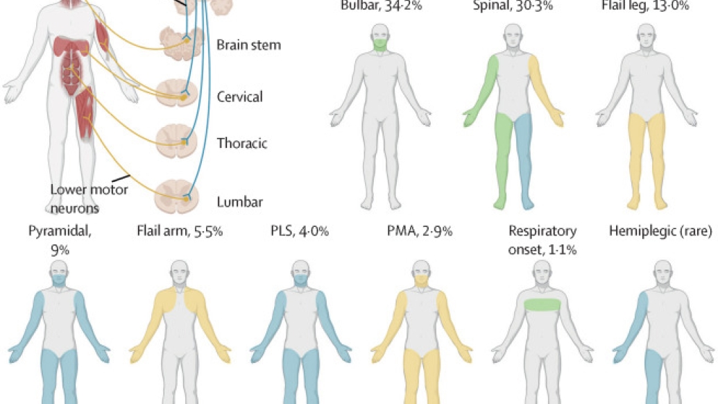 10 Key Facts About ALS In 2023 Michigan Medicine   2022 Lancet Feldman Fig 1ab 