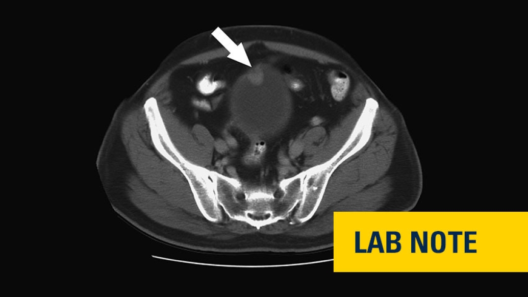 image of a bladder scan