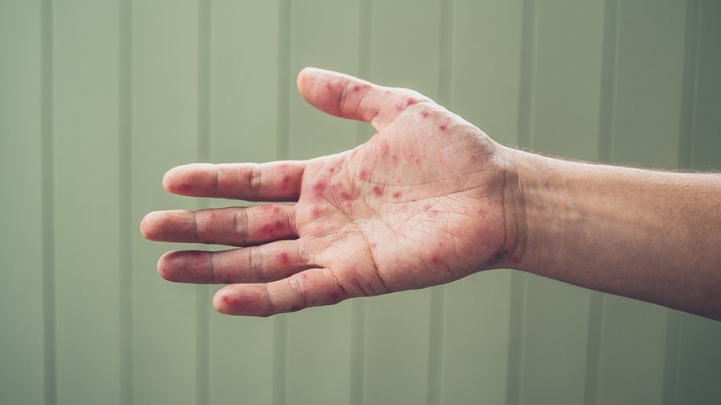 Right hand with blisters from hand, foot, and mouth disease