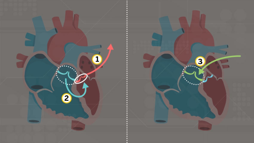 Rare Heart Procedure Keeps Aortic Valve Healthy for Over 20 Years