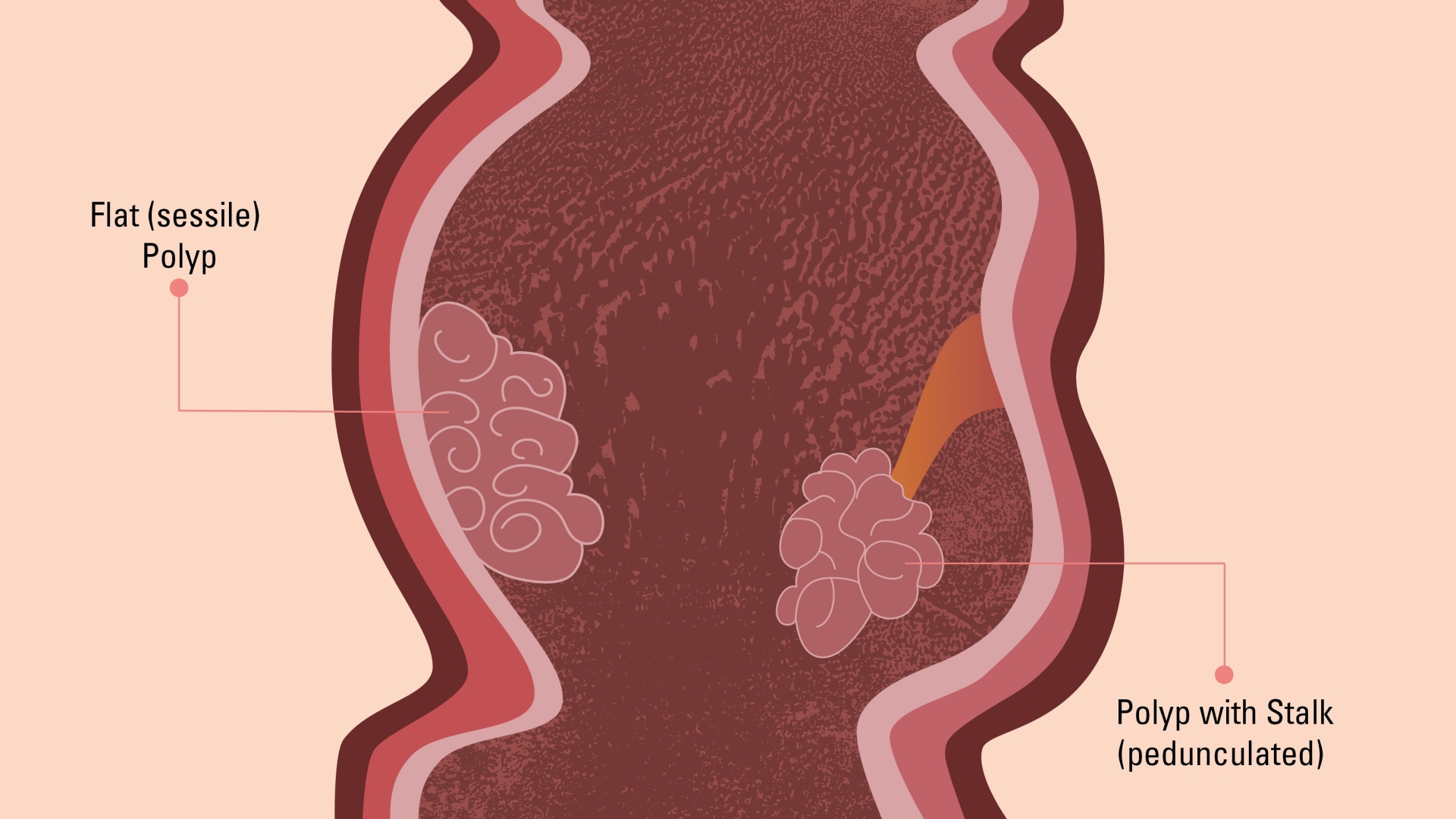 Types Of Colon Polyps Colon Polyp Symptoms And Risk Factors   UMH C COMPLEXPOLYPS%25401x 