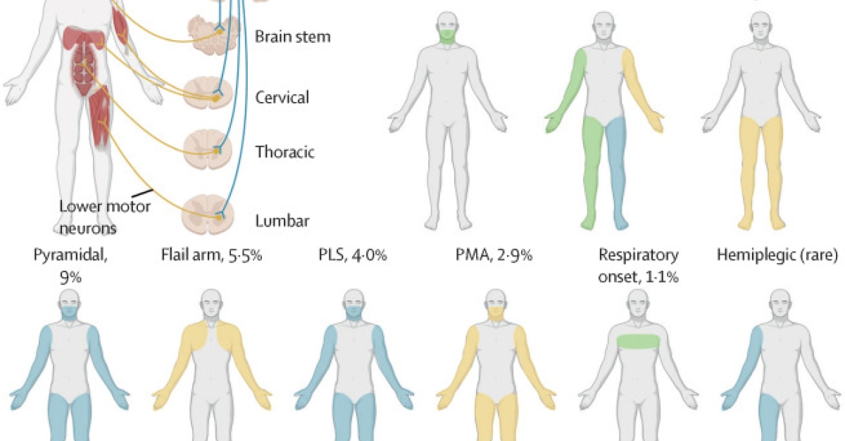 10 Key Facts About ALS in 2023 | Michigan Medicine