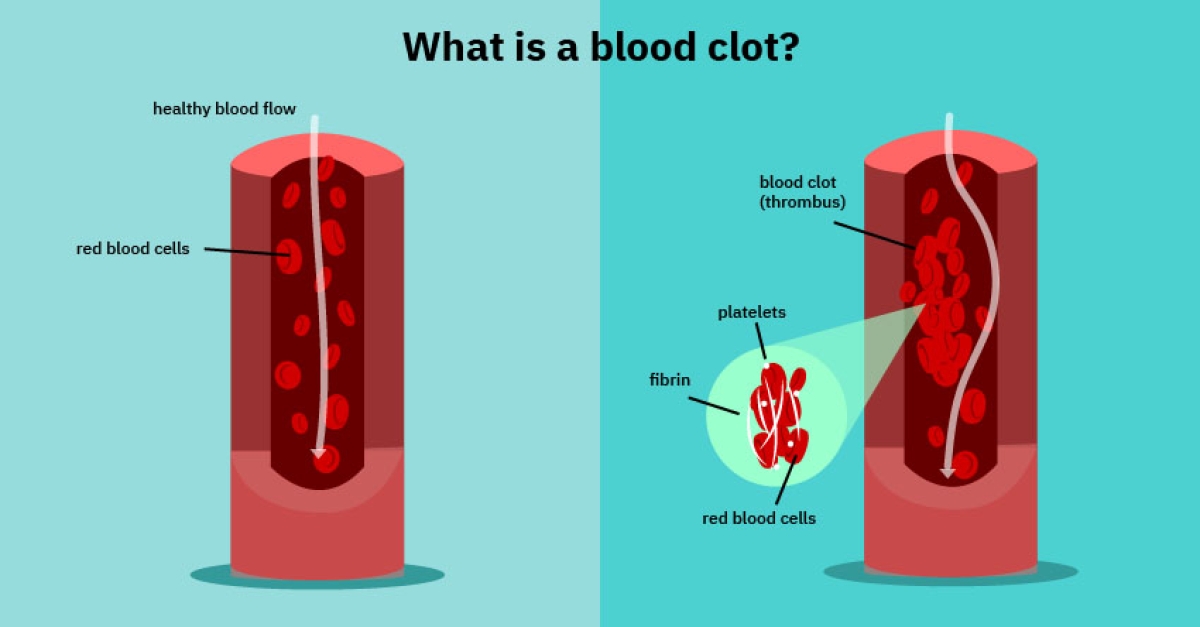 Clots During Your Period Are Not Normal: This Nurse