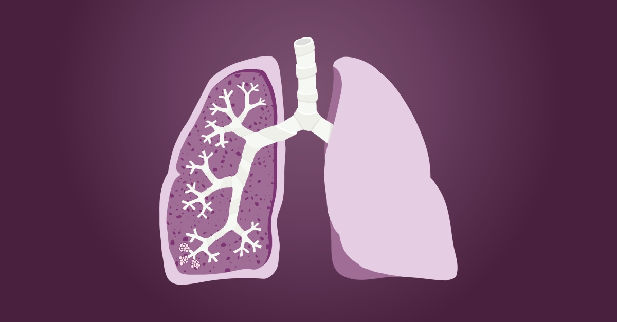 Chronic Rejection in Lung Transplants - the Exploration and Quest to ...