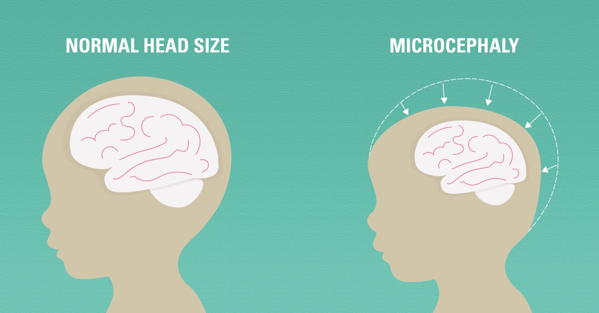 Research on Non-Zika Cases of the Birth Defect Microcephaly