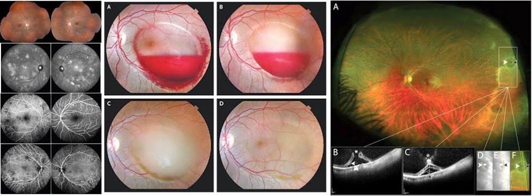 Examples of clinical retina and eye cancer themes studied by the Rajesh Rao Lab